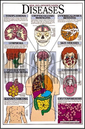 Aids and Opportunistic Diseases Poster